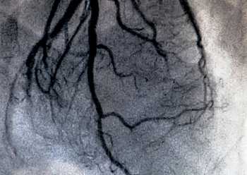 Cardiac PET Viability Scan Cost in Nagpur