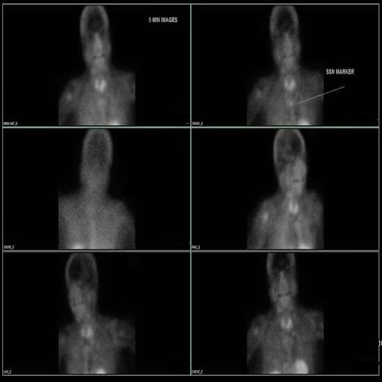 Sesta Mibi Parathyroid Thyroid Scan in Nagpur