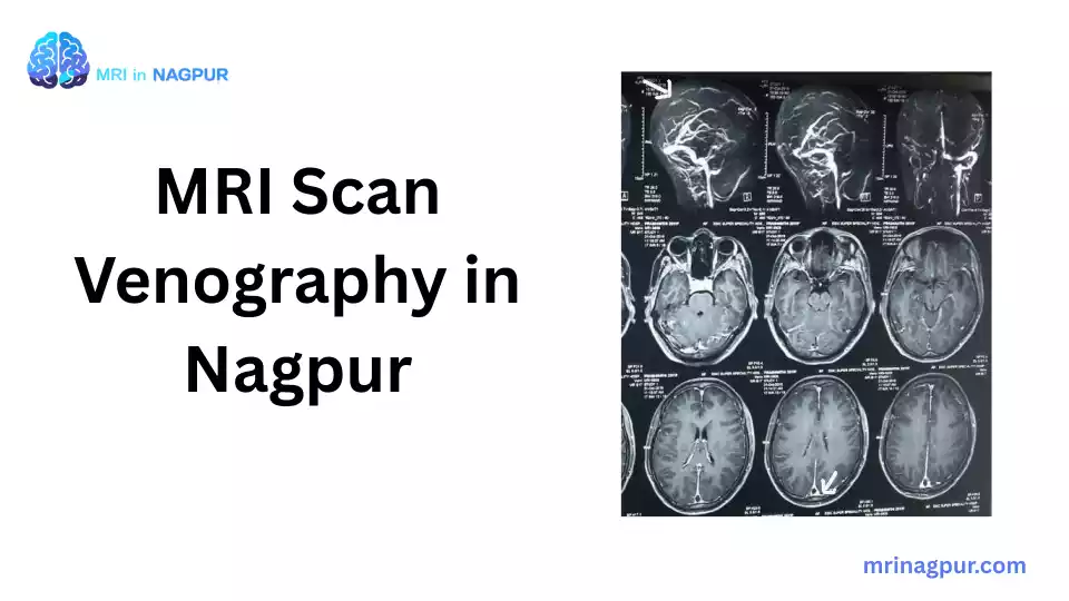 MRI Scan Venography in Nagpur - Nagpur MRI Scan