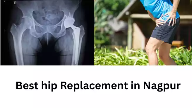 Best hip replacement in Nagpur
